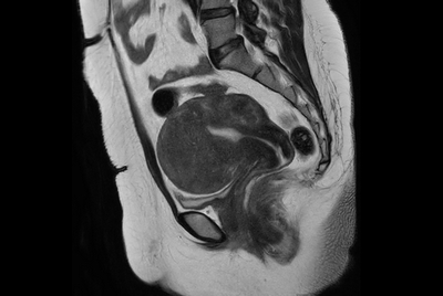 Female pelvis with myoma (Compressed SENSE)