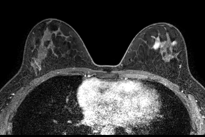 Breast imaging with Compressed SENSE