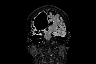 Brain lesion with Compressed SENSE