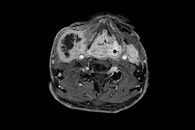 Lymph nodes lesions with Compressed SENSE