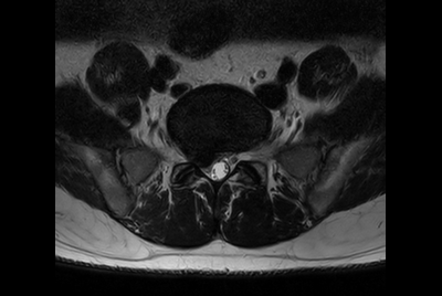 Lumbar Spine stenosis (Compressed SENSE)