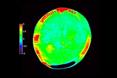3D APT brain imaging for glioblastoma recurrence