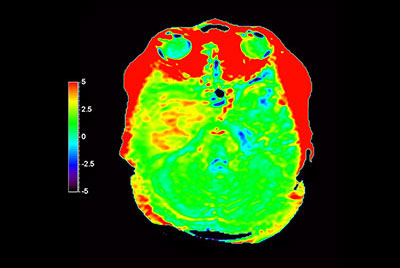 Brain astrocytoma post radiotherapy, incl. 3D APT