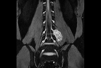 Neurography schwannoma (Compressed SENSE)