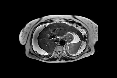 Liver with ascites