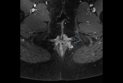 Pelvis with fistula