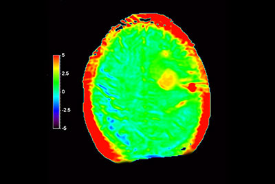 Brain with glioblastoma