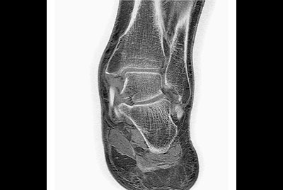 Ankle/Foot imaging post amputation