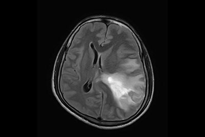 Pediatric Brain with hemorrhagic mass