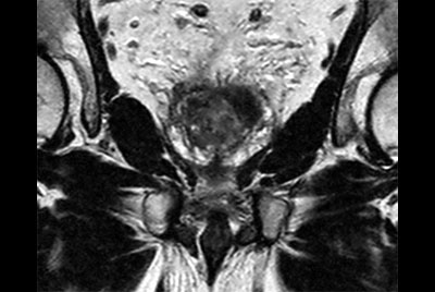 Prostate with the dS Torso coil at 1.5T