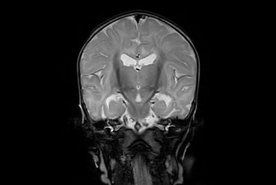 Neonatal Brain