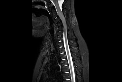 Total Spine on a 14 year old patient