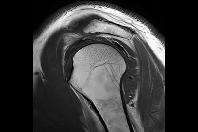 High resolution imaging with the dS 16ch Shoulder coil and Compressed SENSE