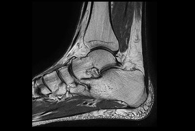 Ankle imaging with the dS 16ch FootAnkle coil