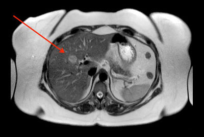 Liver imaging - Obese patient