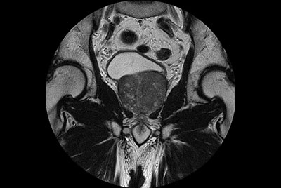 Prostate imaging with motion reduction techniques
