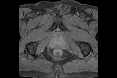 Prostate lesion with fat-free mDIXON XD imaging