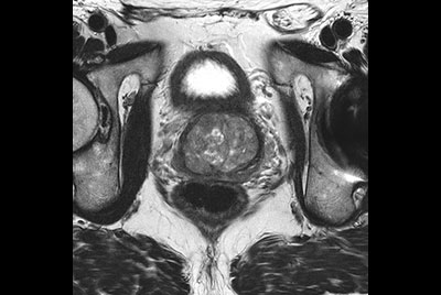 High resolution Prostate imaging with Compressed SENSE