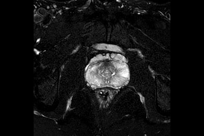 Prostate with dS ZOOM imaging