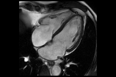 Shorten breath holds in Cardiac imaging on BlueSeal magnet