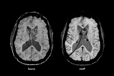 Advanced Neuro MR - SWIp