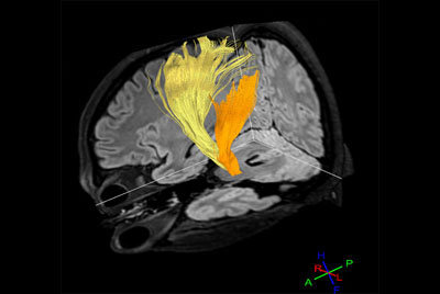 Advanced Brain imaging