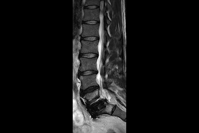 Compressed SENSE for lumbar spine MRI of patient with MR Conditional implant