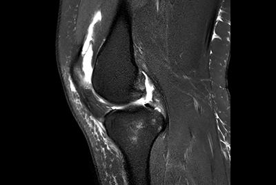 Knee exam with/without Compressed SENSE