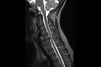 Cervical spine imaging with robust fatsat