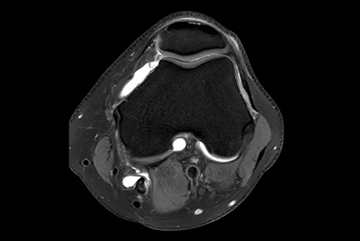 Knee imaging with Compressed SENSE