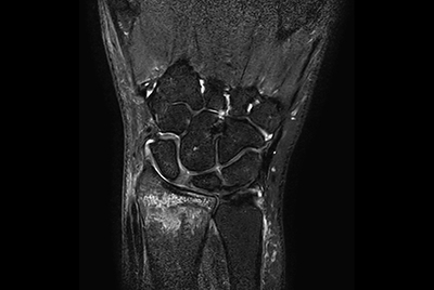 Wrist Fracture (2D vs 3D)