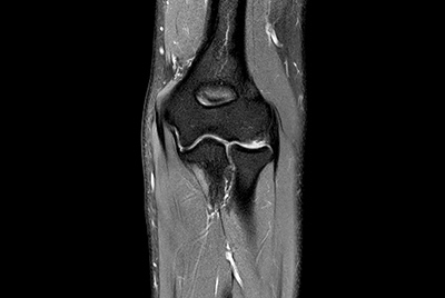 High quality Elbow imaging with Compressed SENSE