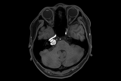 IAC lesion with Compressed SENSE