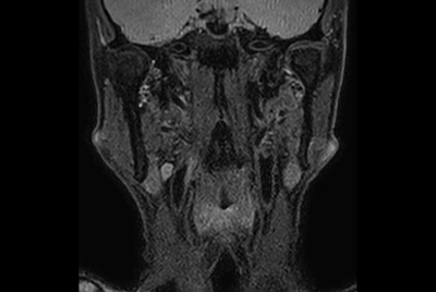 Neck stenosis