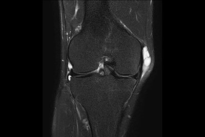 Knee with lesion