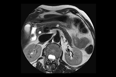 Pancreas nodule – Free breathing