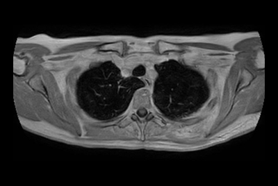 Thorax soft tissue lesion – Free breathing