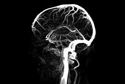 Dynamic contrast-enhanced MR Angiography