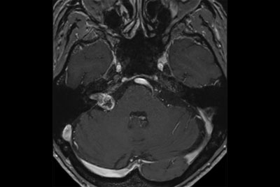 IAC - Acoustic Neuroma