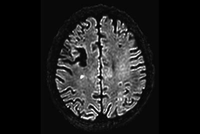 Brain lesions with computed DWI