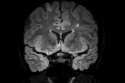 FLAIR* protocol for Multiple Sclerosis