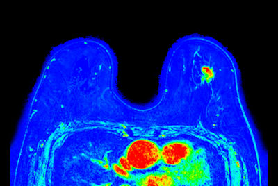 Breast Ca with T1 perfusion