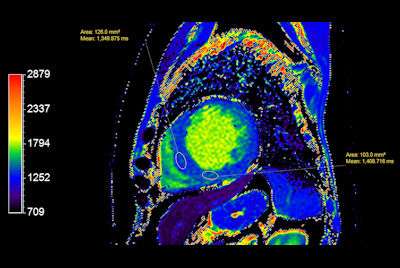 Myocardial infarction with T1/T2 Mapping