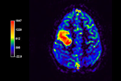 Brain lesion - Advanced imaging