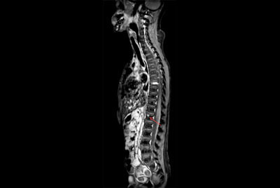 Premium Fat-free Pediatric Spine imaging