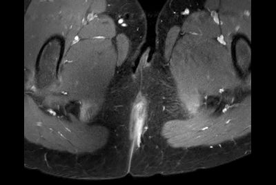 Pediatric pelvis with fistula