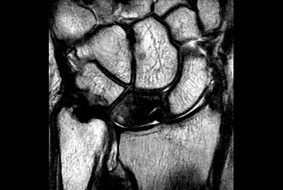 Wrist imaging with micro coil