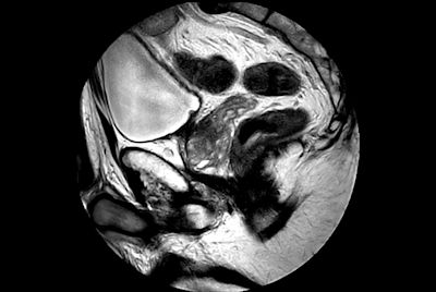 Prostate with dual coil set-up