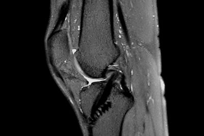 Knee ACL repair