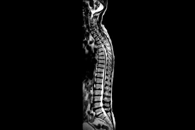 Whole Spine with scoliosis ( 2 stations )